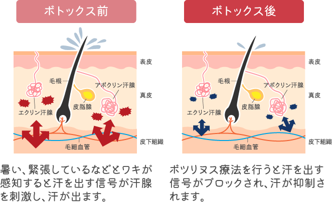 ボトックスで汗が止まる仕組み