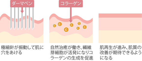 髪の毛よりさらに細くなったダーマペン4