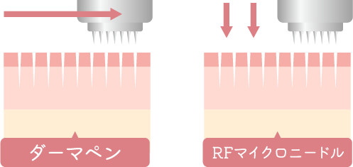 ダーマペン4との原理の違い
