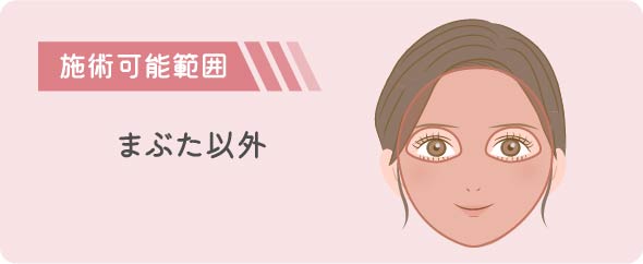 ミルキーライト施術範囲